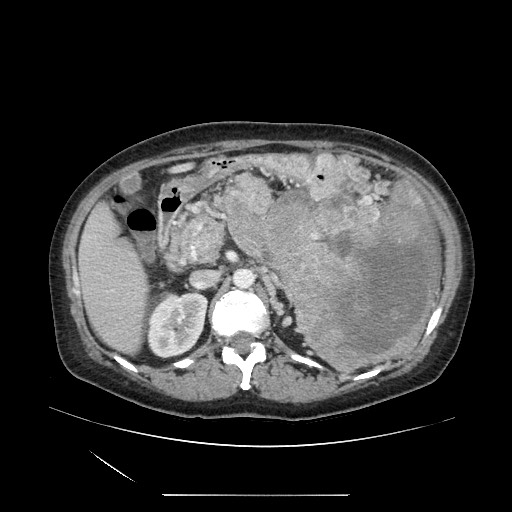 Acinar cell carcinoma of the pancreas (Radiopaedia 75442-86669 Axial C+ portal venous phase 50).jpg