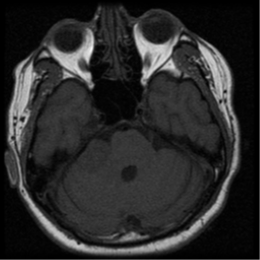 File:Acoustic schwannoma (Radiopaedia 33045-34060 Axial T1 9).png
