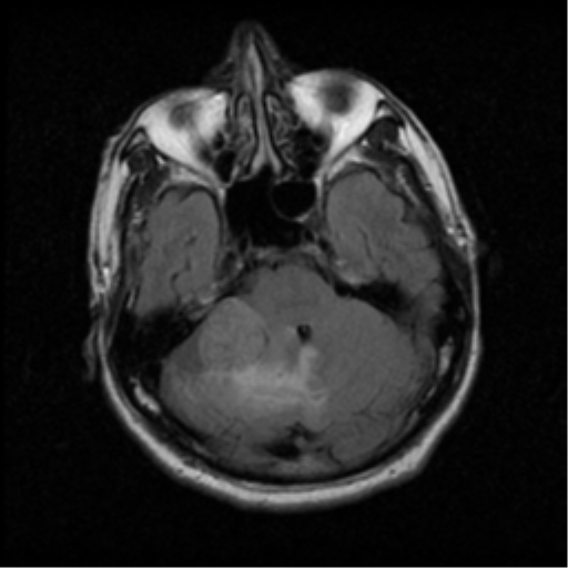 File:Acoustic schwannoma (Radiopaedia 39170-41387 Axial FLAIR 6).png