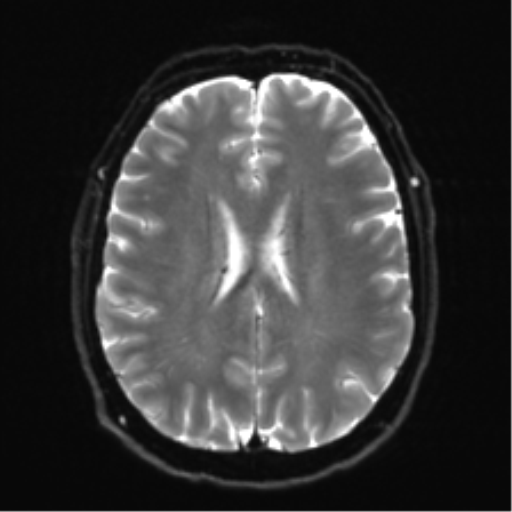 File:Acoustic schwannoma (Radiopaedia 50846-56358 Axial DWI 19).png