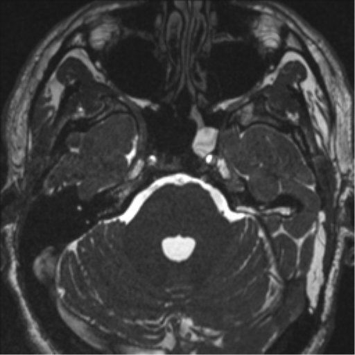 Acoustic schwannoma (translabyrinthine resection) (Radiopaedia 43570-46972 Axial CISS 35).png