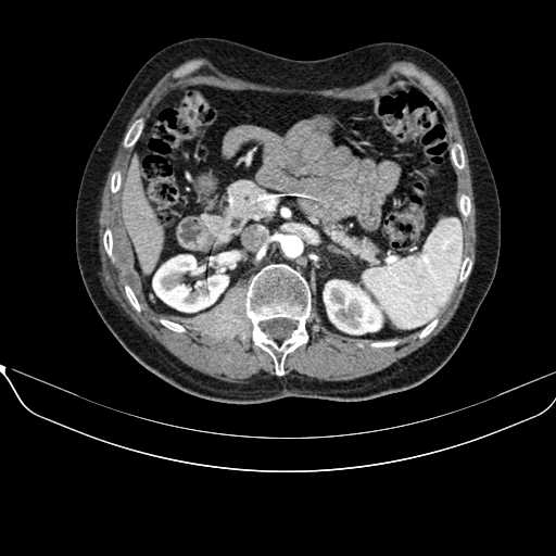 File:Acquired adrenal hyperplasia - due to thymic carcinoid tumor (Radiopaedia 21269-21184 C+ arterial phase 42).jpg