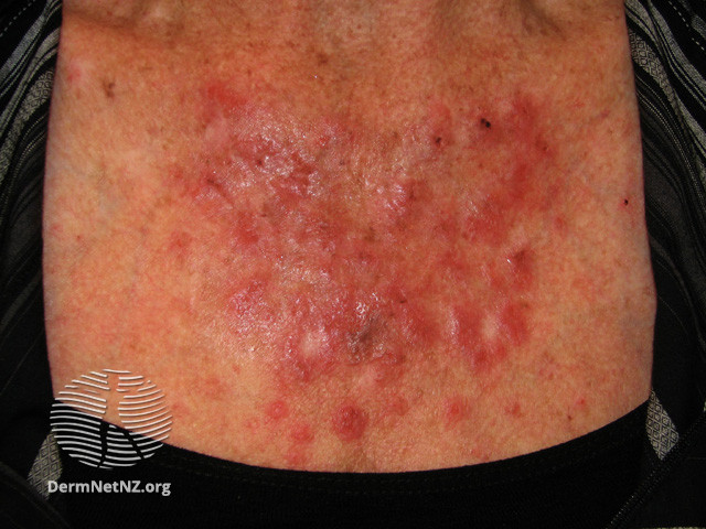 Actinic Keratoses treated with imiquimod (DermNet NZ lesions-ak-imiquimod-3721).jpg