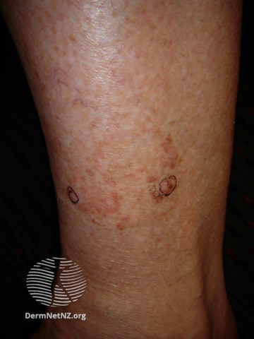 File:Actinic keratoses affecting the legs and feet (DermNet NZ lesions-ak-legs-307).jpg