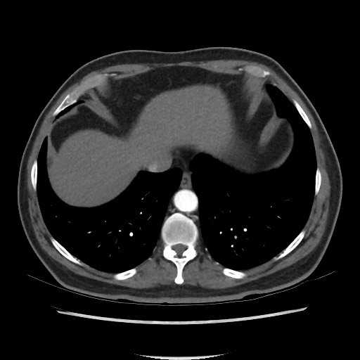 Active colonic bleed on CT (Radiopaedia 49765-55025 Axial C+ arterial phase 10).jpg