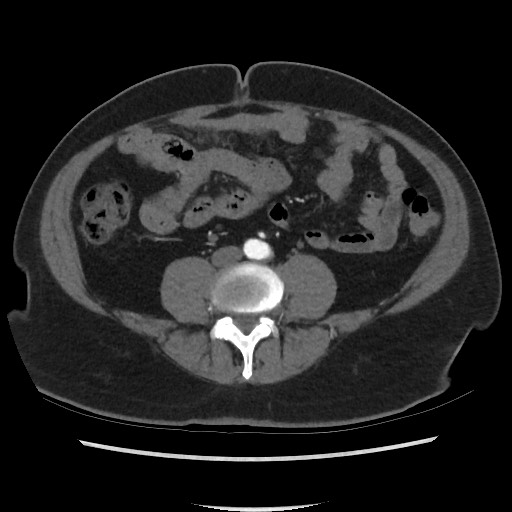 Active colonic bleed on CT (Radiopaedia 49765-55025 Axial C+ arterial phase 50).jpg