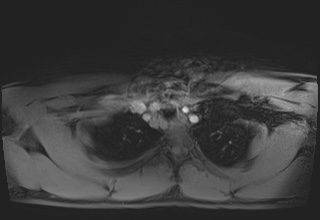 File:Active right ventricular cardiac sarcoidosis (Radiopaedia 55596-62100 Axial Post contrast Dixon 2).jpg
