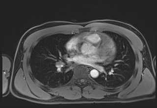 Active right ventricular cardiac sarcoidosis (Radiopaedia 55596-62100 Axial Post contrast Dixon 38).jpg