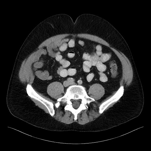 Acute-on-chronic pancreatitis (Radiopaedia 67286-76656 Axial C+ portal venous phase 53).jpg