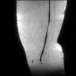 Acute-on-chronic transient lateral patellar dislocation with trochlear dysplasia (Radiopaedia 84099-99349 Sagittal PD 3).jpg