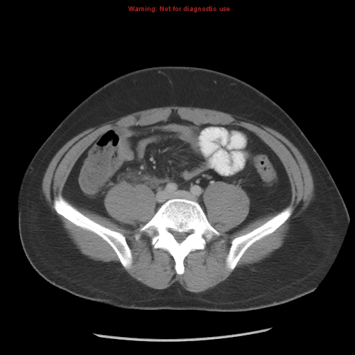 Acute appendicitis (Radiopaedia 10498-10973 Axial C+ portal venous phase 18).jpg