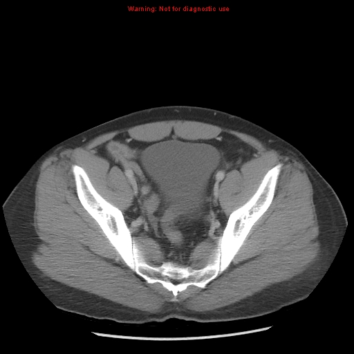 File:Acute appendicitis (Radiopaedia 10498-10973 Axial C+ portal venous phase 44).jpg