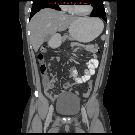 File:Acute appendicitis (Radiopaedia 10498-10973 F 7).jpg