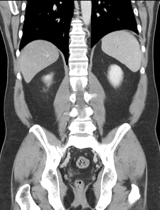 Acute appendicitis (Radiopaedia 36611-38177 Coronal C+ portal venous phase 44).png