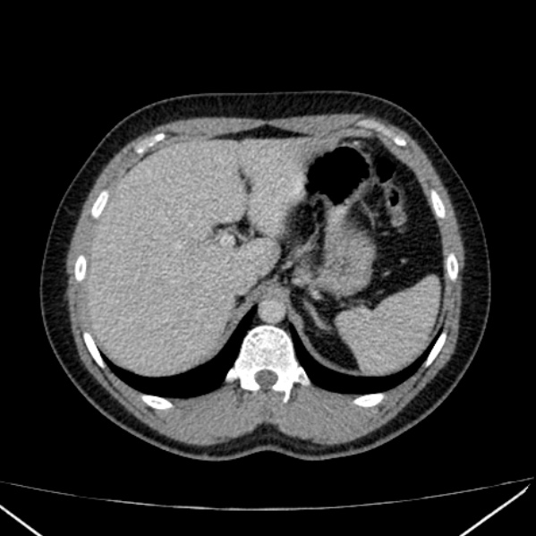 Acute appendicitis (Radiopaedia 38255-40270 Axial C+ portal venous phase 21).jpg