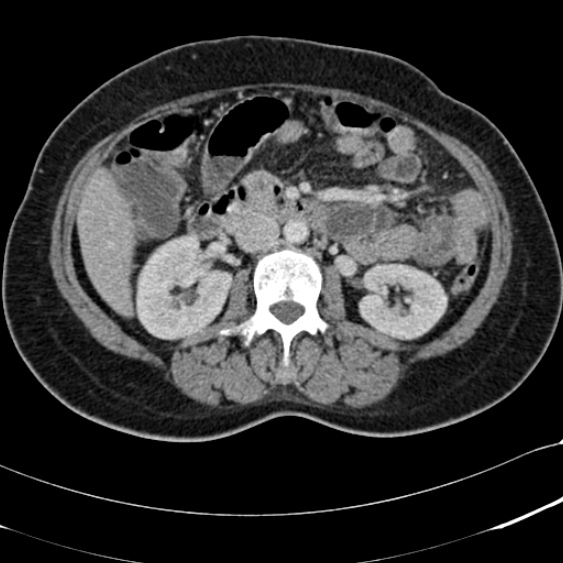 Acute appendicitis (Radiopaedia 48792-53822 Axial C+ portal venous phase 49).jpg