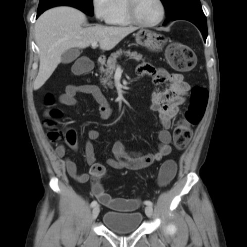 Acute appendicitis (Radiopaedia 66513-75790 Coronal C+ portal venous phase 25).jpg