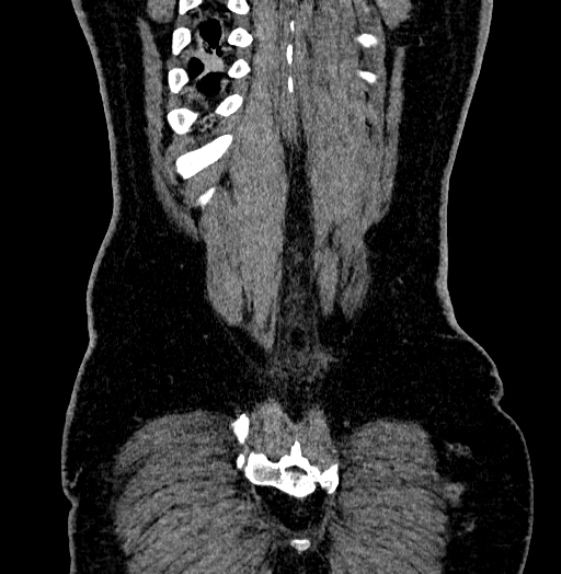 Acute appendicitis (Radiopaedia 79950-93224 Coronal C+ portal venous phase 89).jpg
