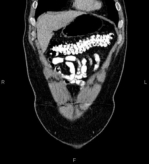 Acute appendicitis (Radiopaedia 84780-100240 Coronal C+ portal venous phase 11).jpg