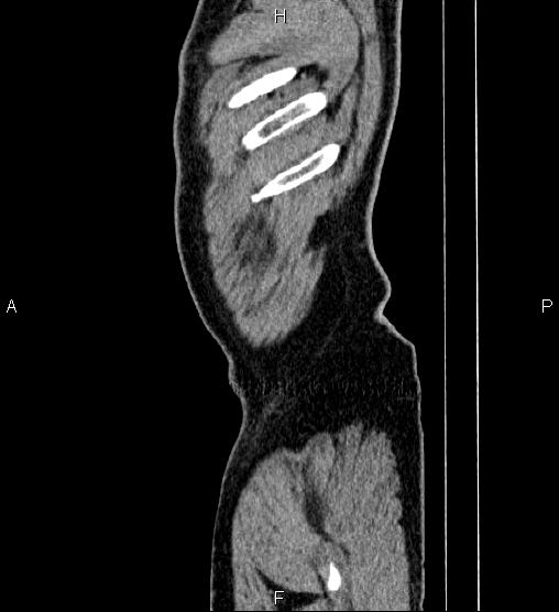 Acute appendicitis (Radiopaedia 84780-100240 Sagittal C+ portal venous phase 107).jpg
