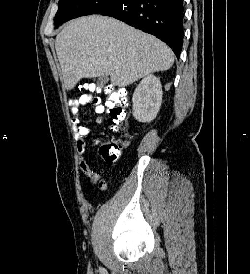 Acute appendicitis (Radiopaedia 84780-100240 Sagittal C+ portal venous phase 23).jpg