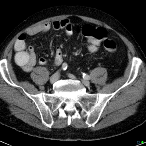 File:Acute appendicitis arising from a malrotated cecum (Radiopaedia 19970-19997 Axial C+ portal venous phase 31).jpg