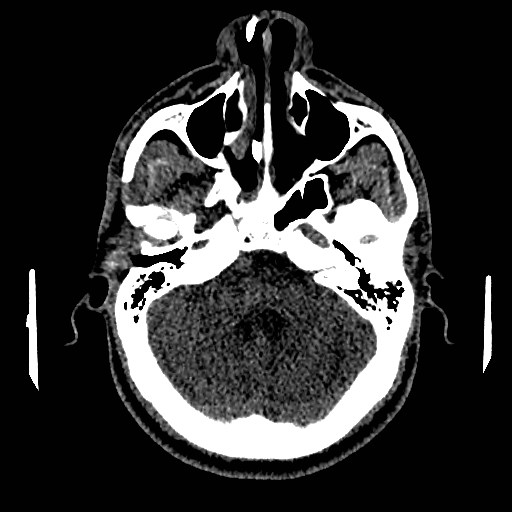 Acute basilar artery occlusion (Radiopaedia 43582-46985 Axial non-contrast 53).jpg