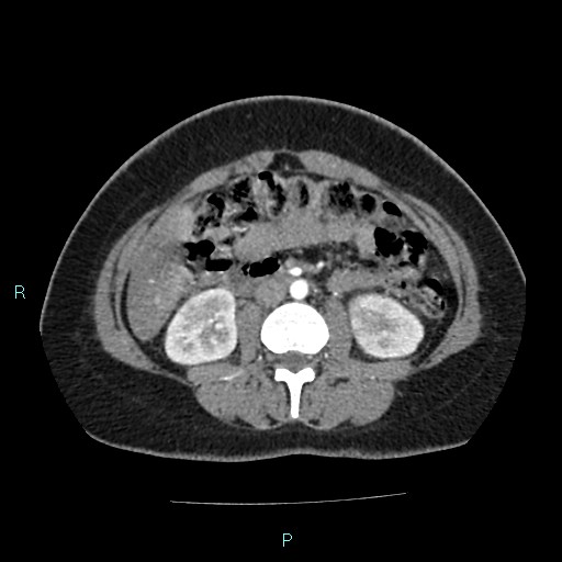 Acute bilateral pyelonephritis (Radiopaedia 37146-38881 Axial C+ arterial phase 95).jpg