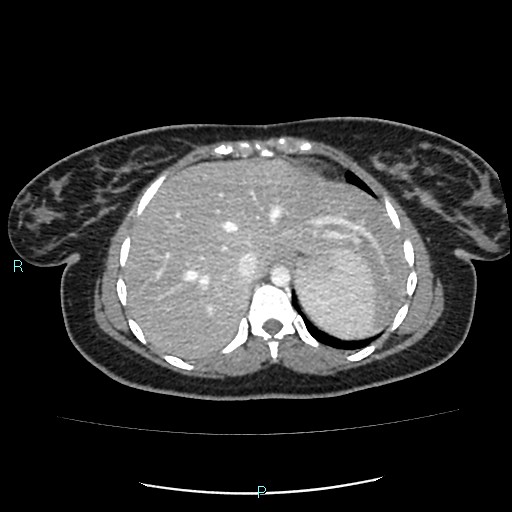 Acute bilateral pyelonephritis (Radiopaedia 37146-38881 Axial C+ portal venous phase 12).jpg