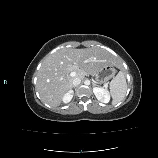 Acute bilateral pyelonephritis (Radiopaedia 37146-38881 Axial C+ portal venous phase 26).jpg