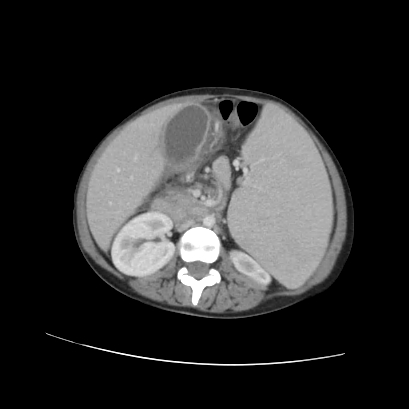 Acute calculous cholecystitis in patient with osteopetrosis (Radiopaedia 77871-90159 Axial C+ portal venous phase 42).jpg