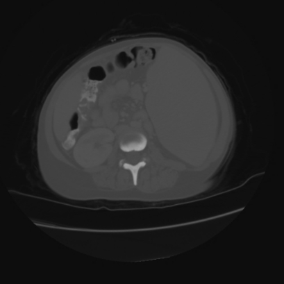 File:Acute calculous cholecystitis in patient with osteopetrosis (Radiopaedia 77871-90159 Axial bone window 27).jpg