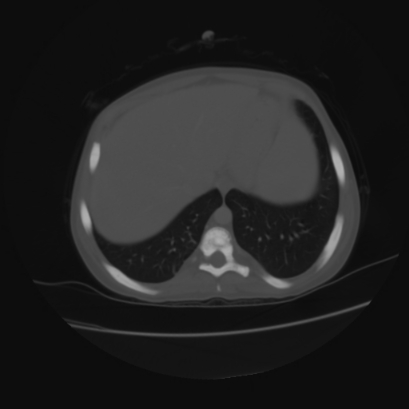 File:Acute calculous cholecystitis in patient with osteopetrosis (Radiopaedia 77871-90159 Axial bone window 6).jpg