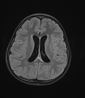 File:Acute cerebellar ataxia (Radiopaedia 61487-69446 Axial FLAIR 13).jpg