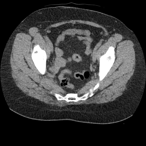 File:Acute cholecystitis and ureteric colic (Radiopaedia 42330-45444 Axial prone 94).jpg