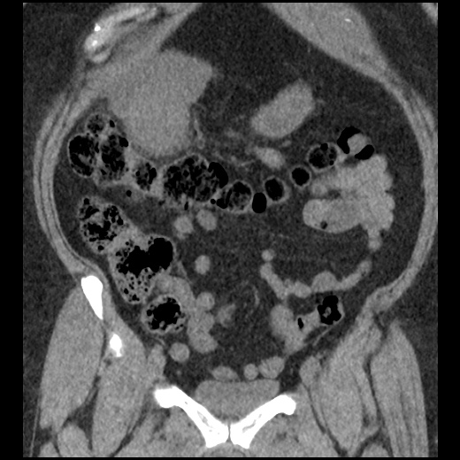 Acute cholecystitis and ureteric colic (Radiopaedia 42330-45444 Coronal prone 35).jpg