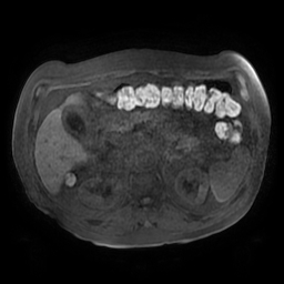 File:Acute cholecystitis complicated by pylephlebitis (Radiopaedia 65782-74915 Axial T1 fat sat 60).jpg