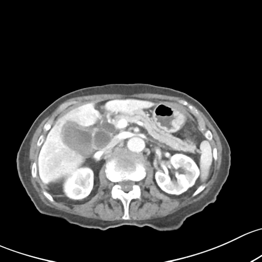 Acute cholecystitis with contained perforation (Radiopaedia 47328-51907 Axial C+ portal venous phase 26).png
