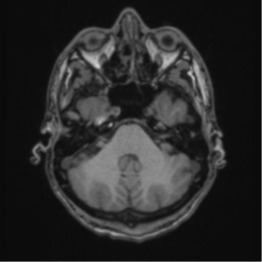 Acute disseminated encephalomyelitis (ADEM) (Radiopaedia 65319-74349 Axial T1 12).png