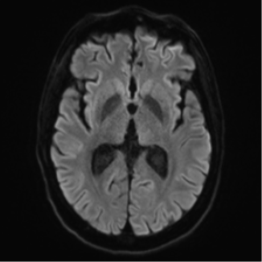 File:Acute disseminated encephalomyelitis (ADEM) (Radiopaedia 65319-74350 Axial DWI 15).png