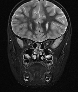 File:Acute disseminating encephalomyelitis with bilateral optic neuritis (Radiopaedia 79676-92886 Coronal STIR 10).jpg