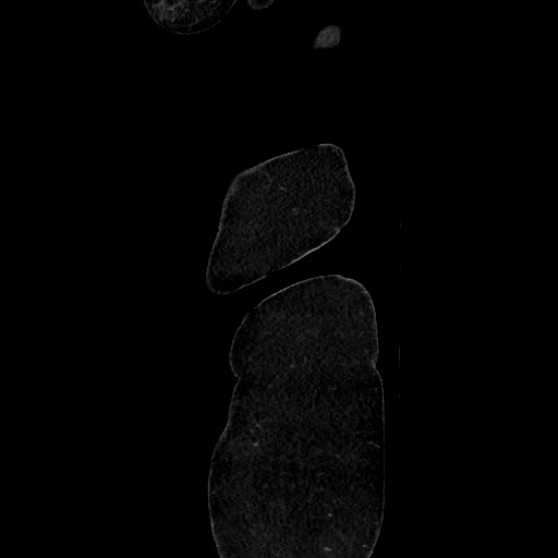 Acute diverticulitis - transverse colon (Radiopaedia 87063-103327 Sagittal C+ portal venous phase 19).jpg