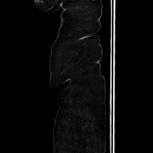 Acute diverticulitis - transverse colon (Radiopaedia 87063-103327 Sagittal C+ portal venous phase 29).jpg