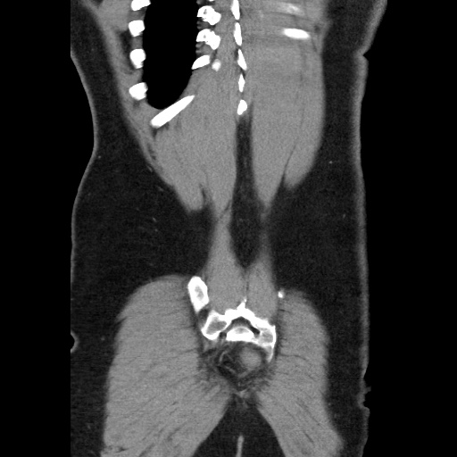 File:Acute diverticulitis with localized perforation (Radiopaedia 41296-44113 Coronal C+ portal venous phase 56).jpg