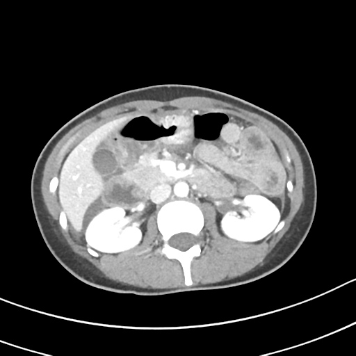 Acute gangrenous appendicitis with perforation (Radiopaedia 40152-42662 Axial C+ portal venous phase 26).png