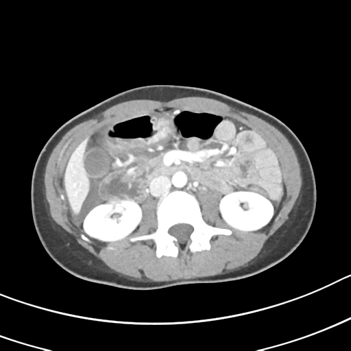 Acute gangrenous appendicitis with perforation (Radiopaedia 40152-42662 Axial C+ portal venous phase 30).png