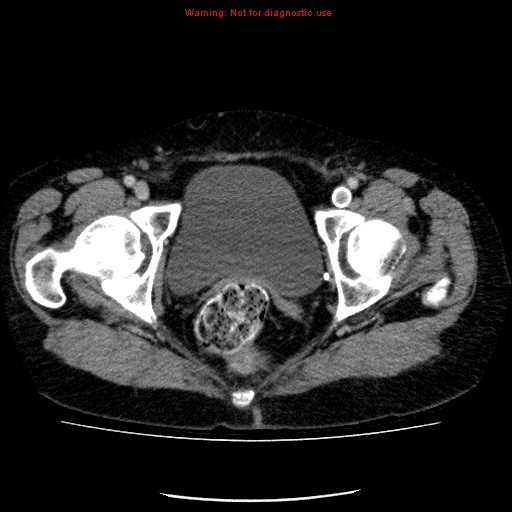 File:Acute gangrenous cholecystitis (Radiopaedia 10123-10661 Axial C+ portal venous phase 97).jpg