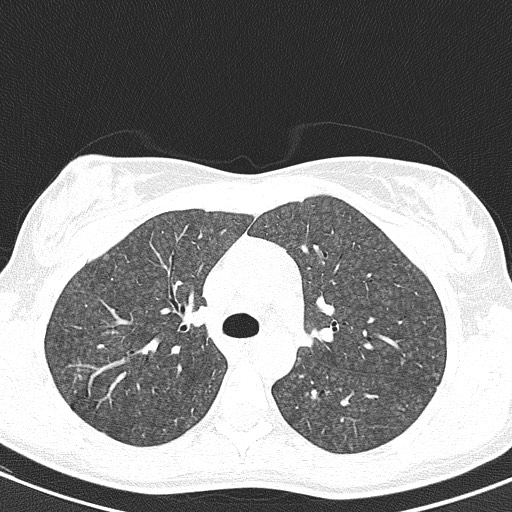 File:Acute hypersensitivity pneumonitis (Radiopaedia 85293-100870 Axial lung window 38).jpg
