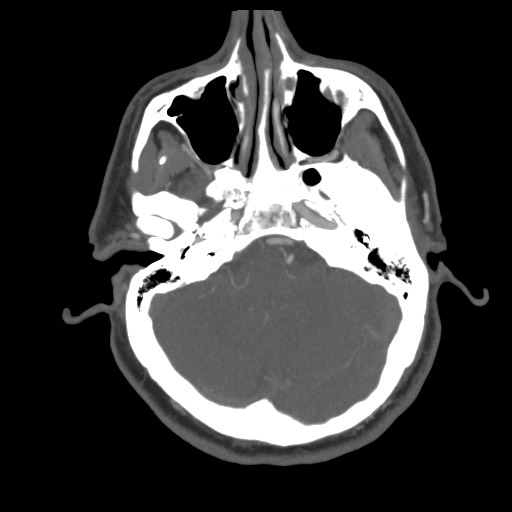 File:Acute internal carotid artery dissection (Radiopaedia 53541-59630 D 19).jpg
