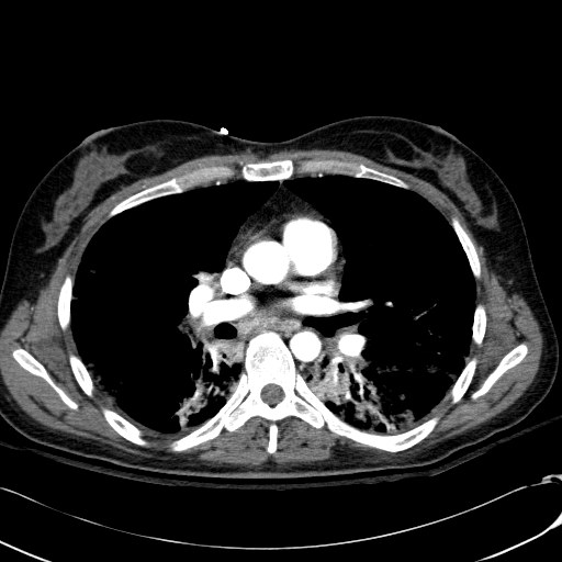 Acute myocardial infarction in CT (Radiopaedia 39947-42415 Axial C+ arterial phase 65).jpg